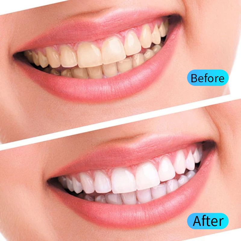 Kit gel sbiancante per denti I - Teeth Whitening Opalescence recensione e prezzo
