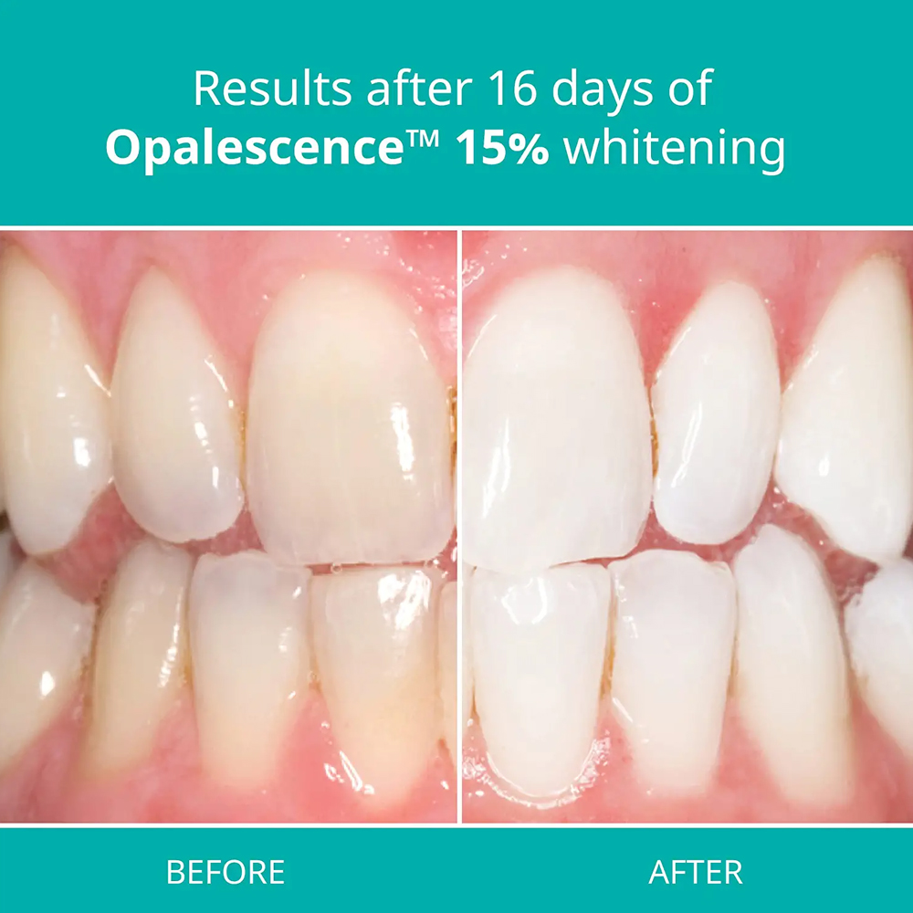 Kit sbiancante professionale O - Teeth Whitening Opalescence recensione e prezzo