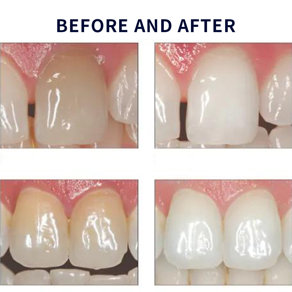 Opalescence Whitening 20% PF 2 - Teeth Whitening Opalescence recensione e prezzo