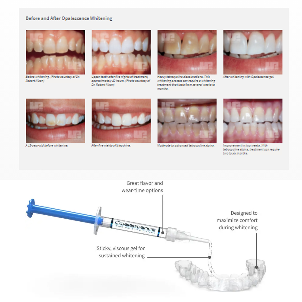 Opalescence Whitening 20% PF 2 - Teeth Whitening Opalescence recensione e prezzo