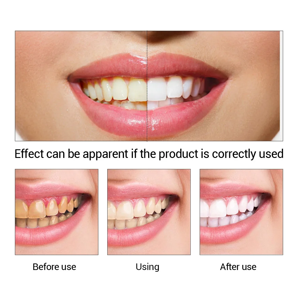 FTEENPLY Sbiancamento Dei Dent - Teeth Whitening Q&M recensione e prezzo