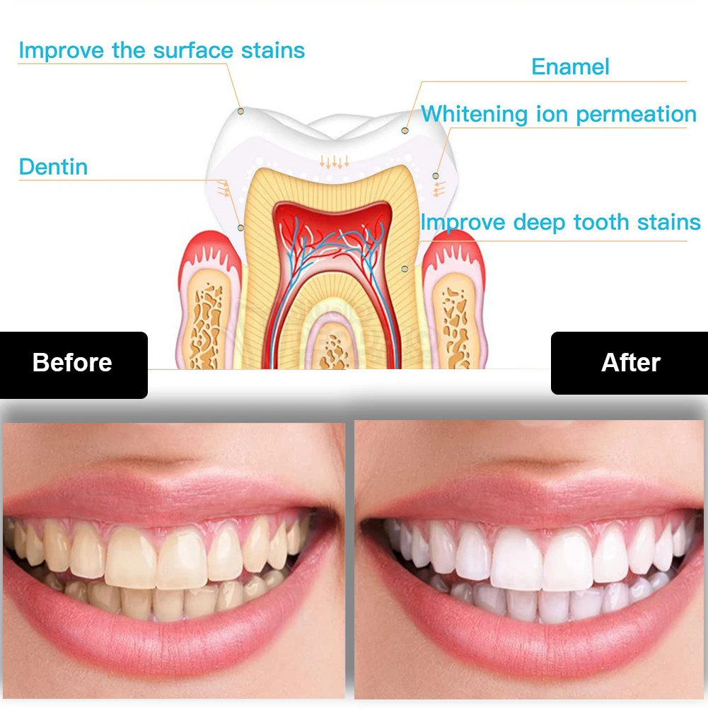 Kit per sbiancamento dei denti - Teeth Whitening Opalescence recensione e prezzo